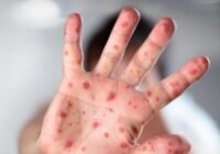 Մոնղոլիայում կարմրուկով բնակիչների վարակվելու թիվը գերազանցել է 14 հազարը